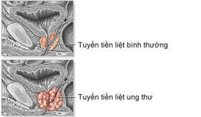 Các yếu tố nguy cơ của ung thư tiền liệt tuyến