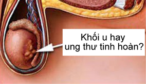 Chuẩn đoán ung thư tinh hoàn