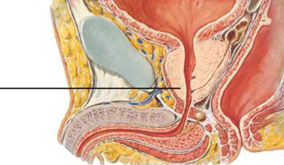U phì đại lành tính tiền liệt tuyến.
