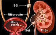 Túi sa niệu quản.