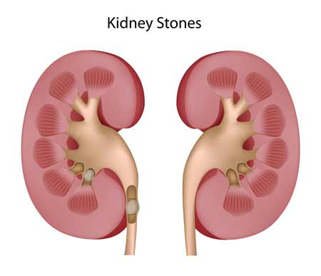 Bệnh nhân sỏi thận: Lo lắng tìm giải pháp điều trị