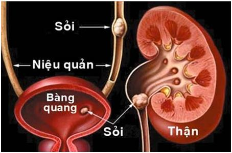 bệnh sỏi thận