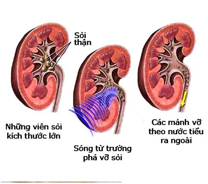 phương pháp chữa bệnh sỏi thận