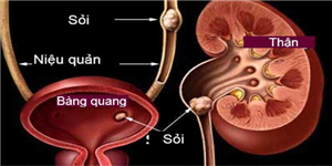Sỏi bàng quang và những điều cần biết