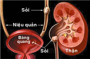 Những lưu ý khi mắc sỏi thận