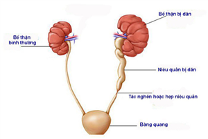 Điều trị hẹp niệu quản với “vũ khí” mới