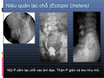 Niệu quản lạc chỗ