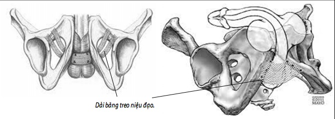 Sức khỏe & đời sống (Bộ y tế): Hết lo són tiểu sau mổ tuyến tiền liệt