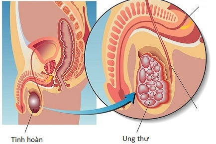 Sức khỏe & đời sống (Bộ y tế): Ung thư tinh hoàn: biết sớm, chữa nhanh