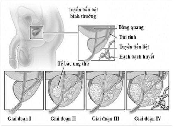 Sức khỏe & đời sống (Bộ y tế): Hủy bỏ nội tiết tố nam trị ung thư tiền liệt tuyến