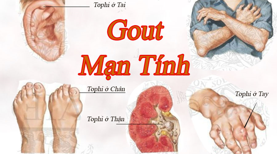 Sức khỏe & đời sống (Bộ y tế): Có thể trị dứt điểm sỏi do gút?