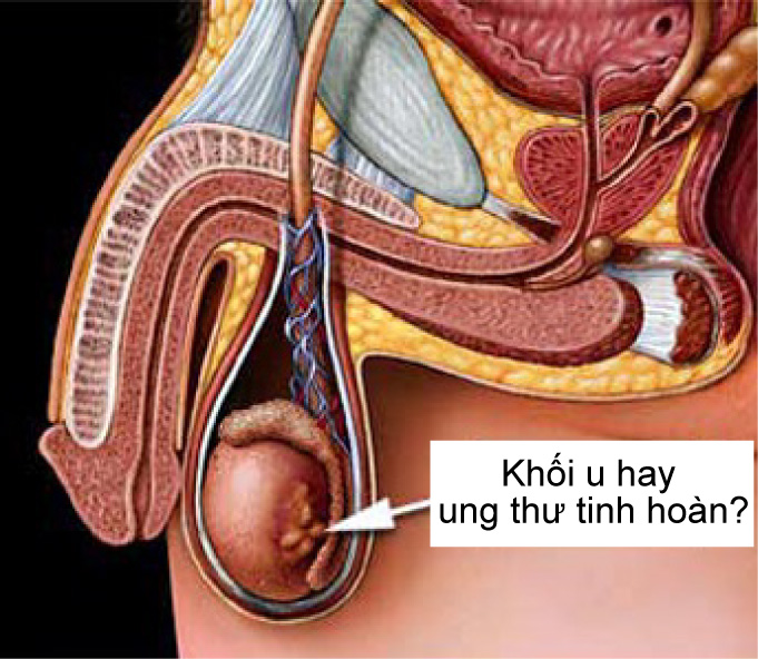Chẩn đoán ung thư tinh hoàn Chẩn đoán ung thư tinh hoàn