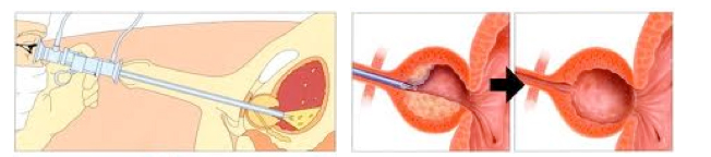 bệnh tiền liệt tuyến