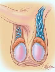Image result for varicocele