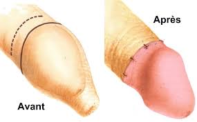 hẹp bao quy đầu ở trẻ em