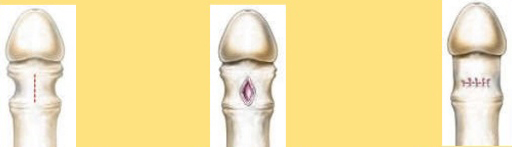 hẹp bao quy đầu