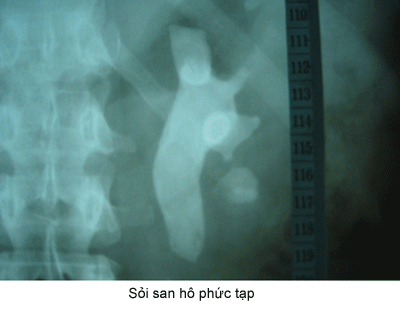 nội soi sỏi thận qua da
