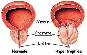 Dân trí: Phì đại tuyến tiền liệt liệu có đáng sợ?