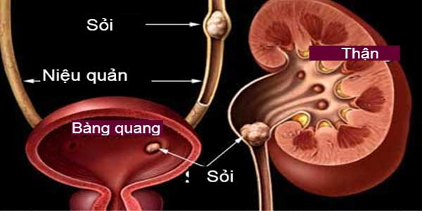Sỏi bàng quang và những điều cần biết
