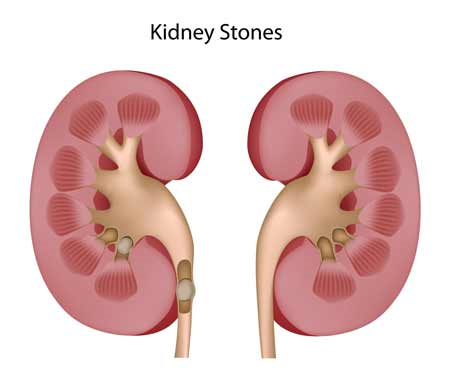 Dân trí: Bệnh nhân sỏi thận: Lo lắng tìm giải pháp điều trị.