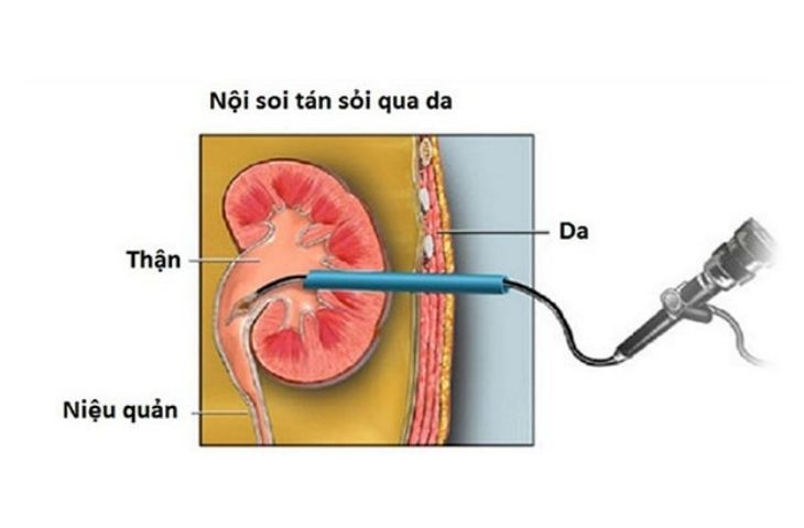 Quy trinh tan soi than qua da 1